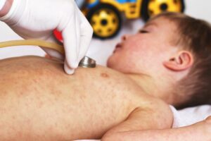 what is roseola