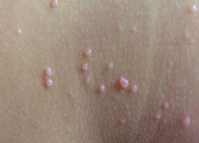 Molluscum Contagiosum