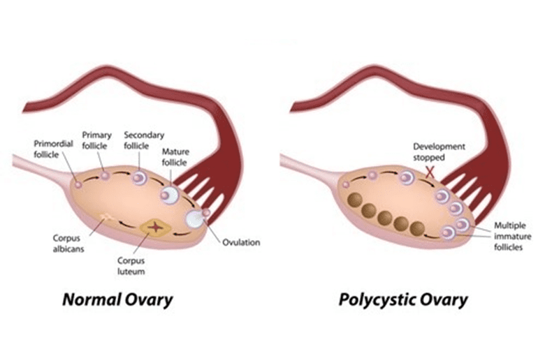 polycystic ovaries